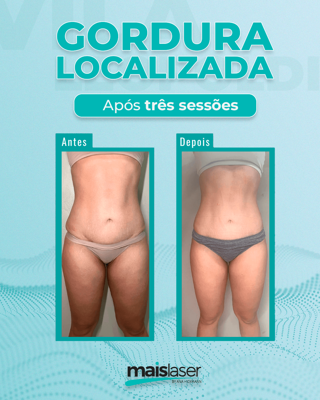 Gordura Localizada