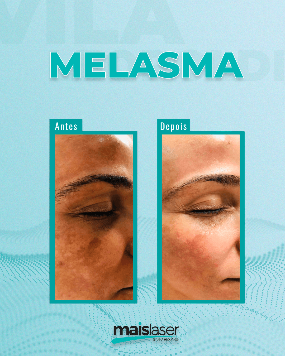 Melasma