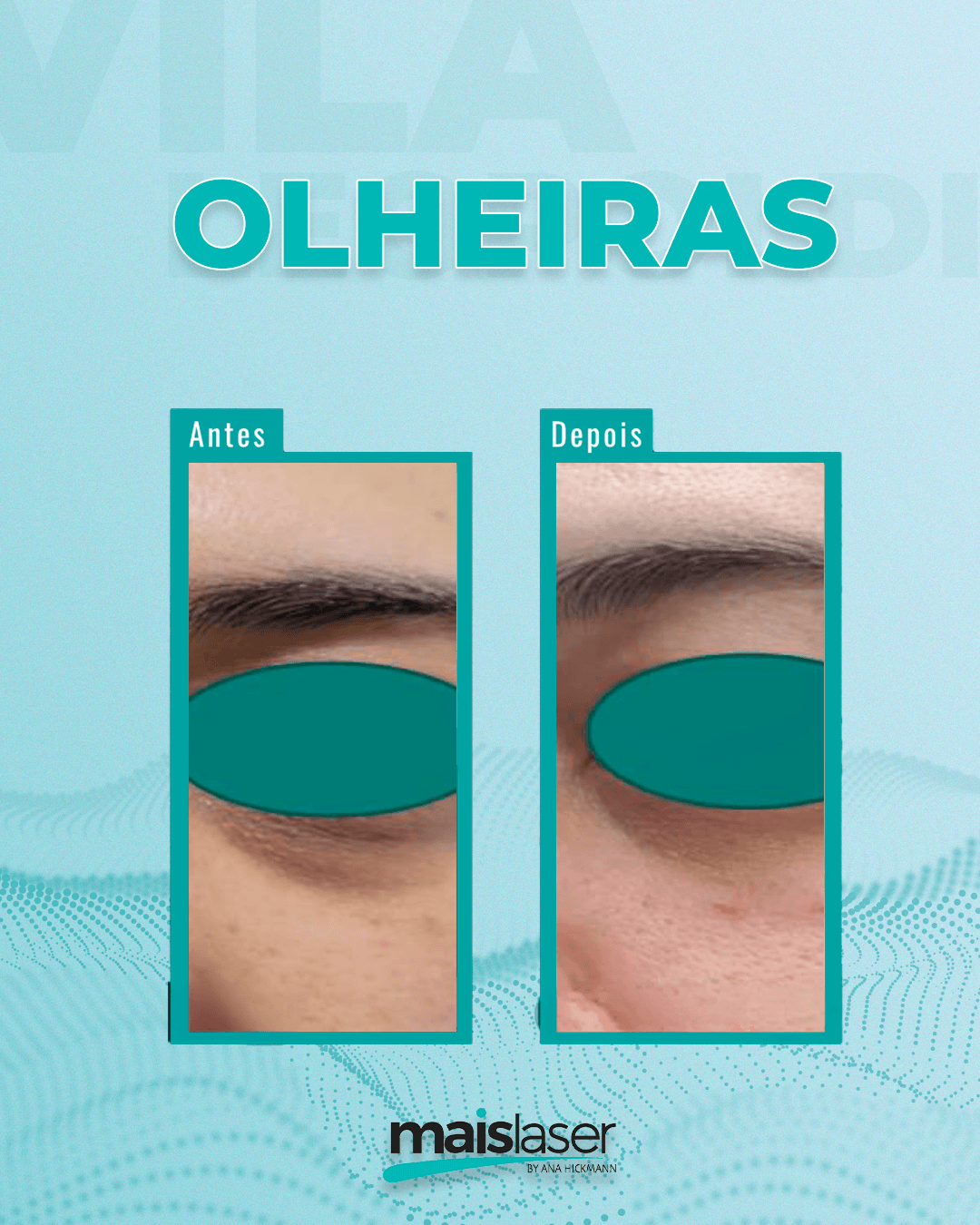 Olheiras