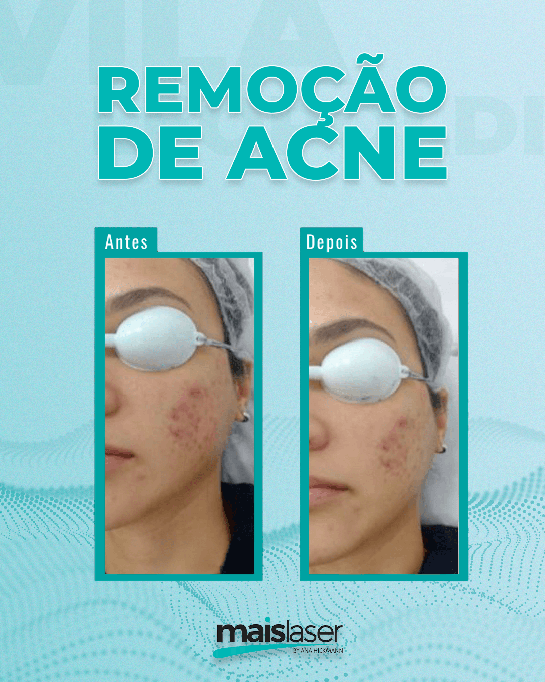 Remoção de Acne