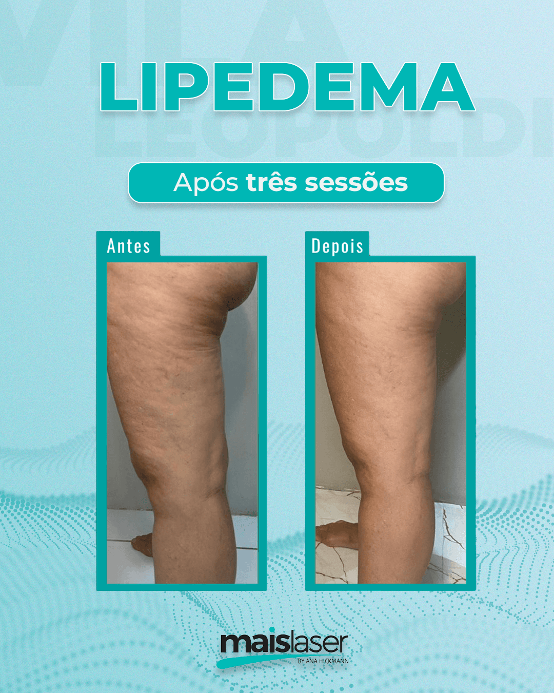 Remoção de Lipedema