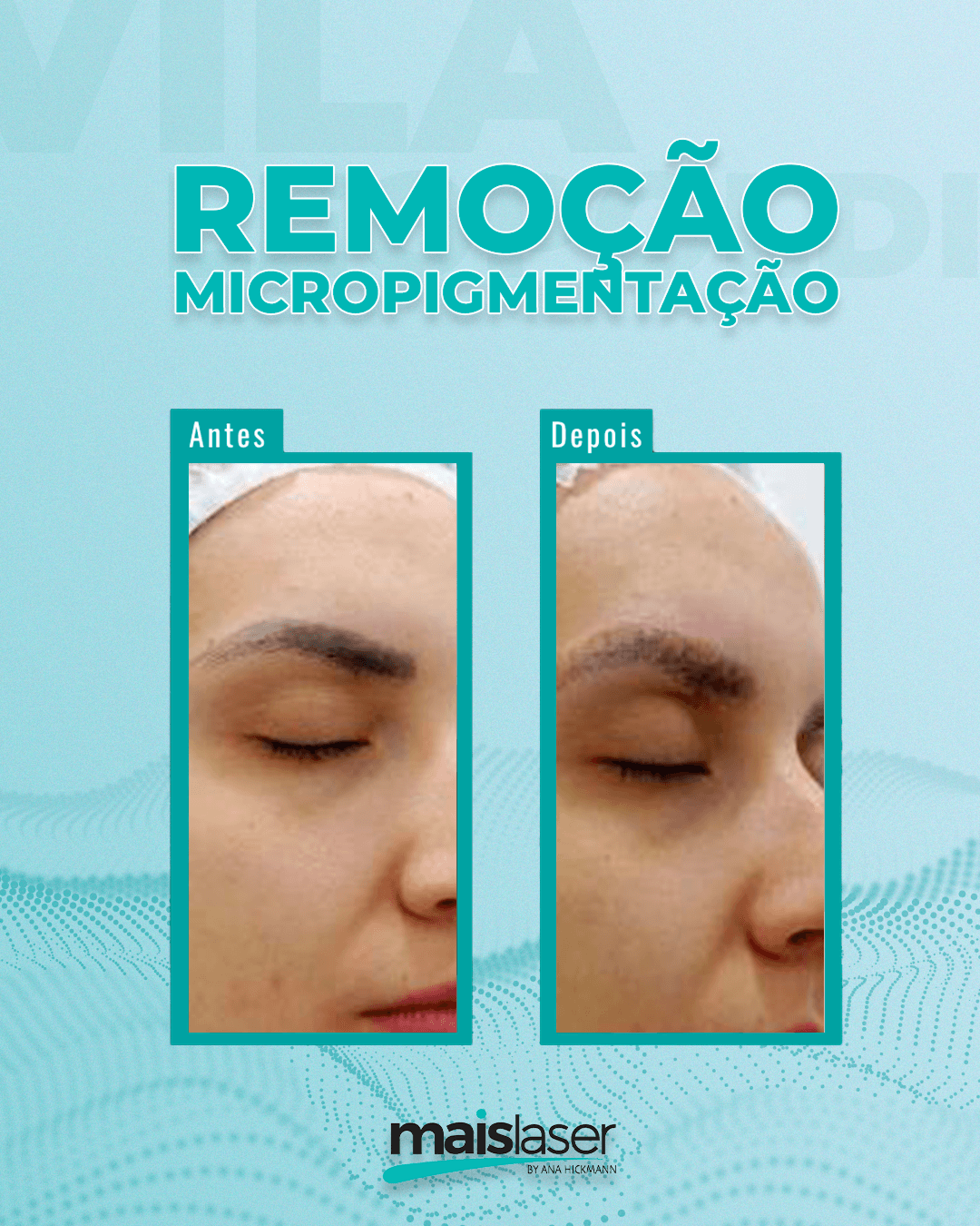 Remoção de Micropigmentação