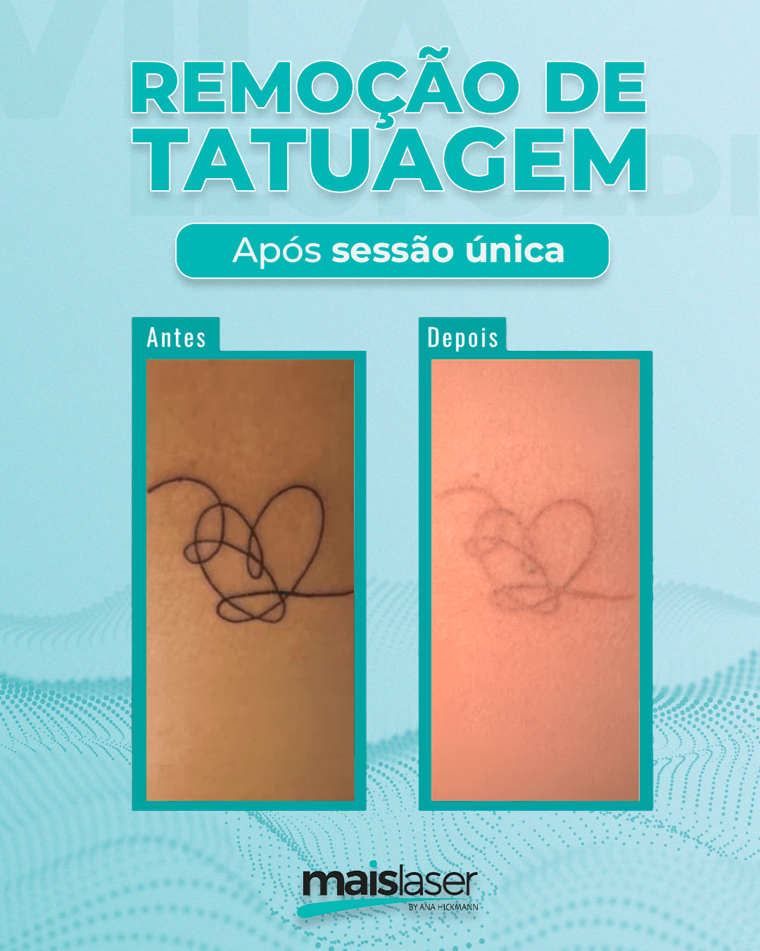 Remoção de Tatuagem