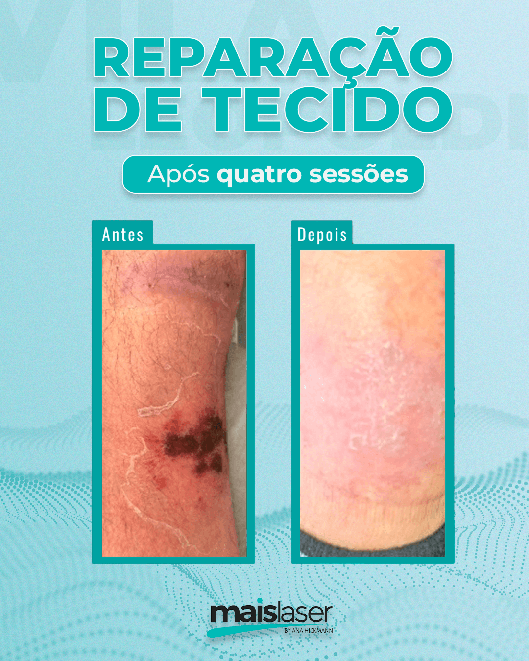 Reparação de Tecido